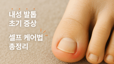 내성발톱 초기증상, 발톱 옆 통증, 살 파고드는 발톱, 셀프 치료, 자가 관리, 발톱 붓기, 내성발톱 예방, 발톱 병원 가기 전 케어