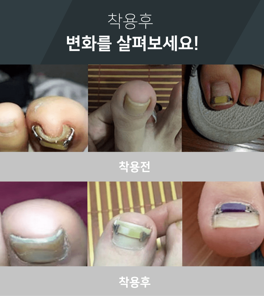 라이언문 내성 발톱 교정기 착용법 5 라텍스 내성발톱교정기 착용 변화 효과