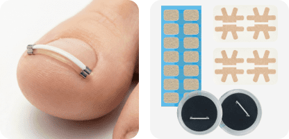 내성발톱 자주 묻는 질문 : 라이언문 NiTi 와이어 교정기