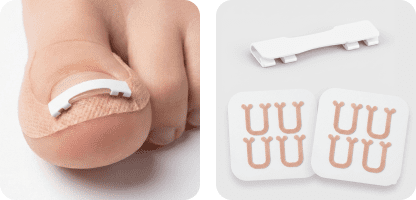 니티놀 내성발톱 교정기 비교 추천