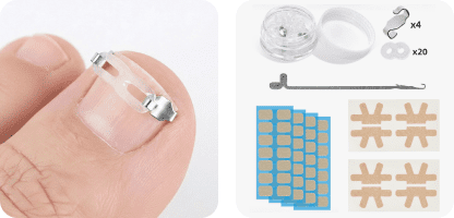 슬림핏 내성발톱 교정기 비교 추천